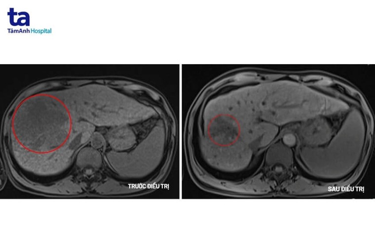 Đau tức hạ sườn đi khám phát hiện ung thư gan giai đoạn cuối ảnh 1