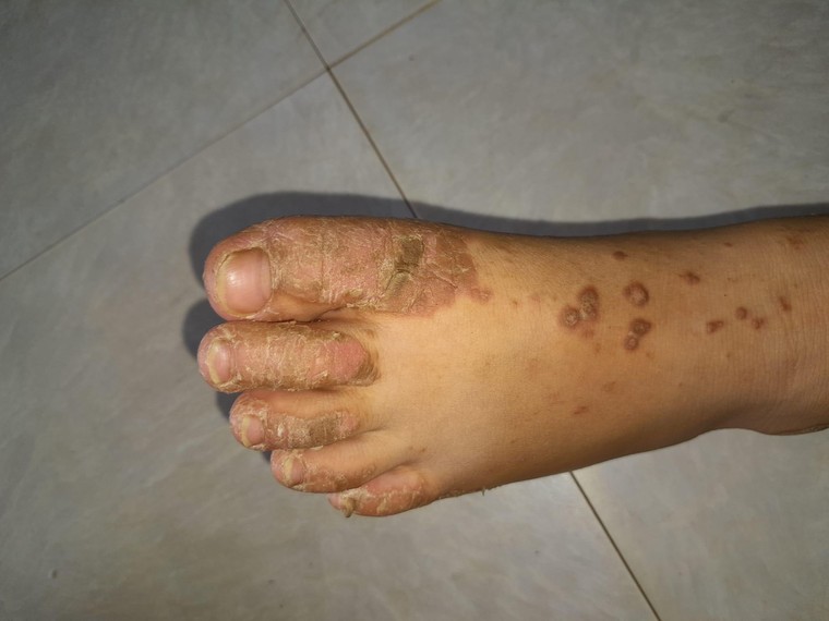 Vảy nến - Sống chung với những tổn thương thầm lặng ảnh 1