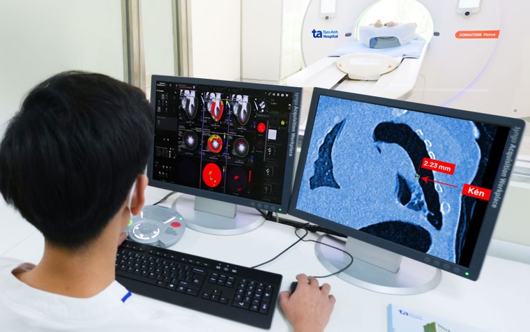 Bệnh viện Đa khoa Tâm Anh sở hữu siêu máy chụp CT thế hệ mới nhất ảnh 4