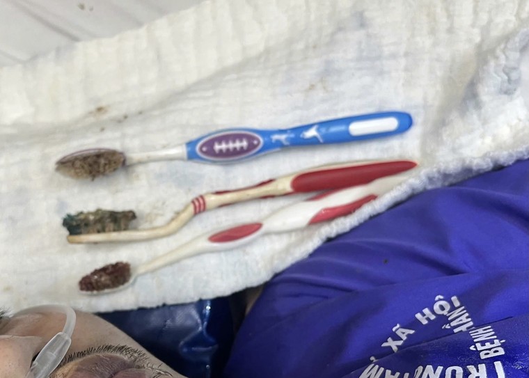 Nội soi cứu người nuốt ba bàn chải đánh răng ảnh 1