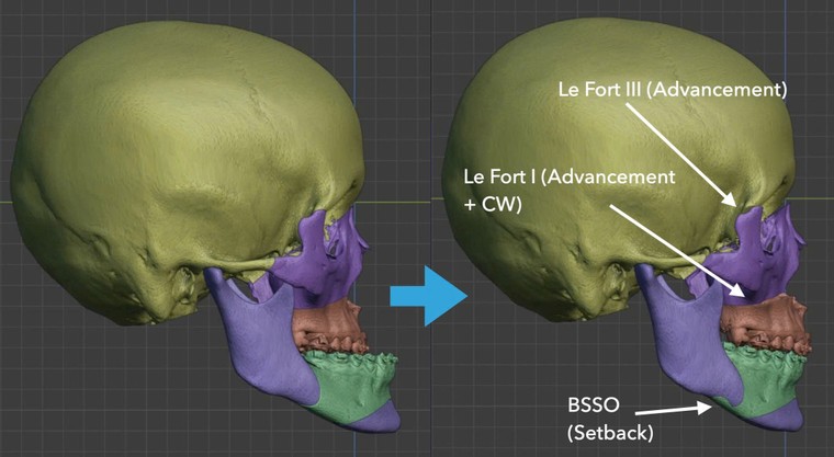 Điều trị móm do xương hàm ảnh 6