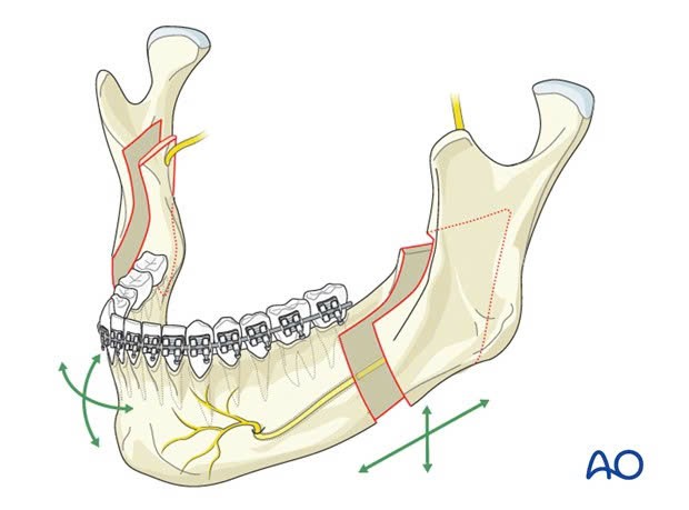 Điều trị móm do xương hàm ảnh 5