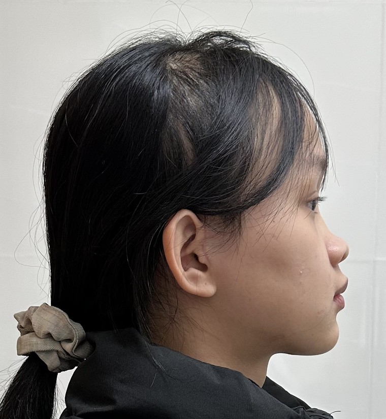 Điều trị móm do xương hàm ảnh 7