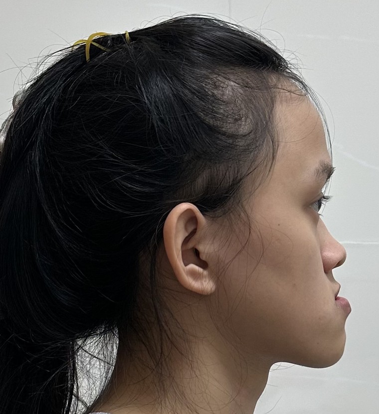 Điều trị móm do xương hàm ảnh 3