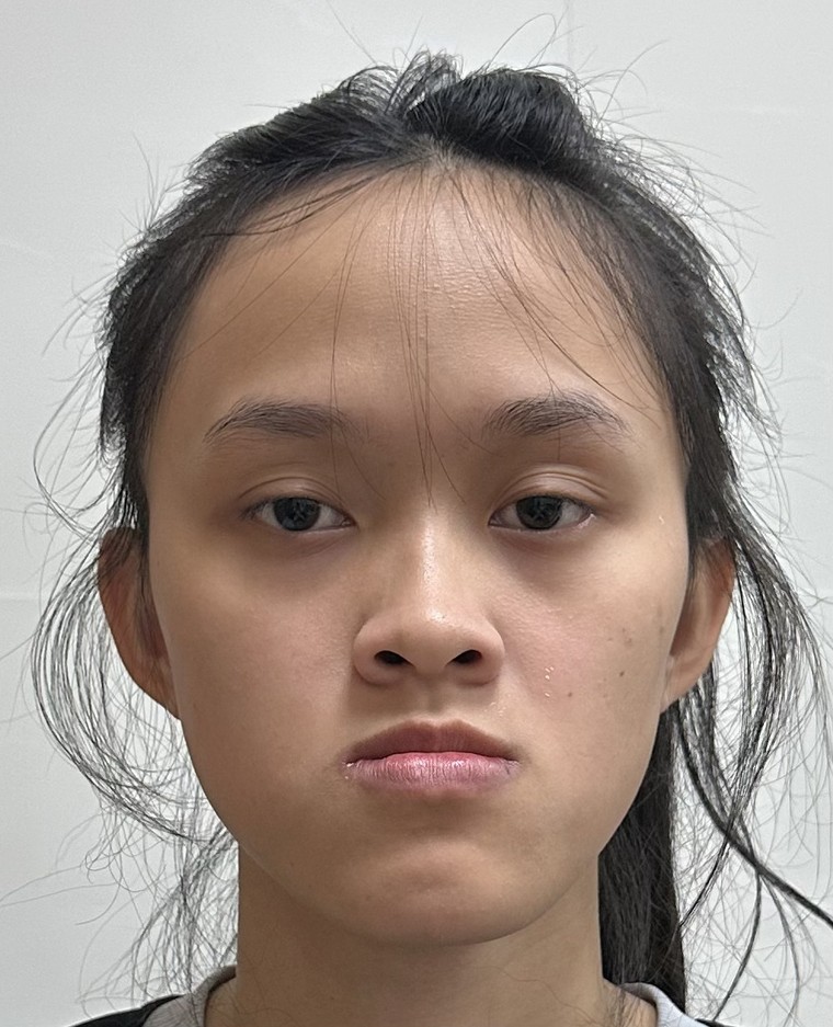 Điều trị móm do xương hàm ảnh 2