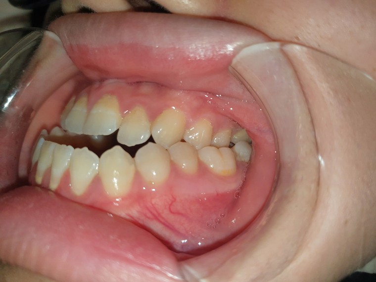 Điều trị móm do xương hàm ảnh 1