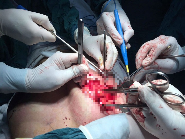 Nâng ngực, sửa mũi: Đẹp chốc lát, khổ cả đời ảnh 2