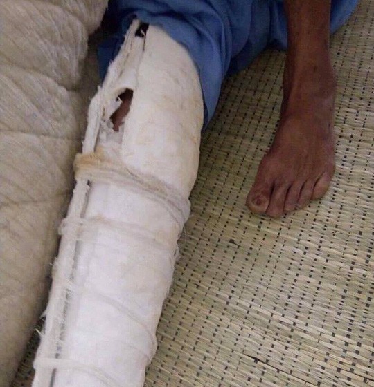 Con trai đánh bố gãy xương sườn, mẻ xương chân và bánh chè ảnh 1