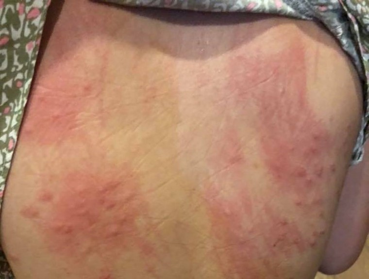 Biển Đà Nẵng an toàn, vậy nguyên nhân gây ngứa là gì? ảnh 1