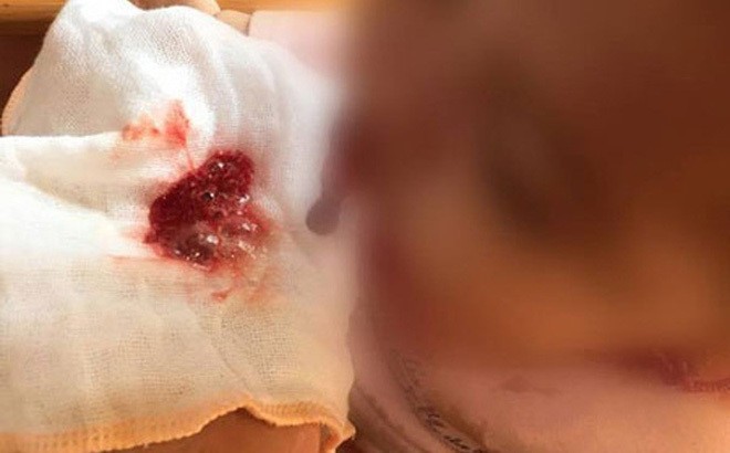 Viêm tuỵ cấp ở trẻ em như bệnh nhi 11 tuổi nguy hiểm thế nào? ảnh 2