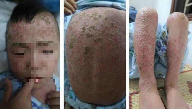 Em bé vảy nến ở Cao Bằng hồi phục ngoạn mục sau 10 ngày được cứu từ bản làng ảnh 1