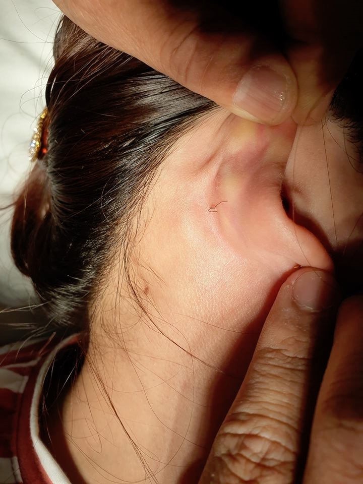 Hoại tử mũi, nát ngực vì làm đẹp đón Tết ảnh 2