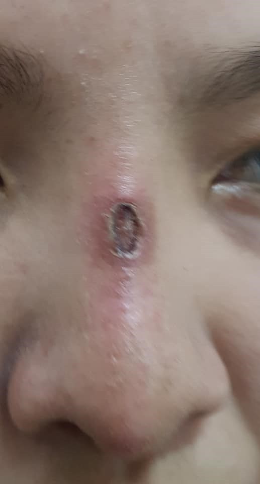 Hoại tử mũi, nát ngực vì làm đẹp đón Tết ảnh 1