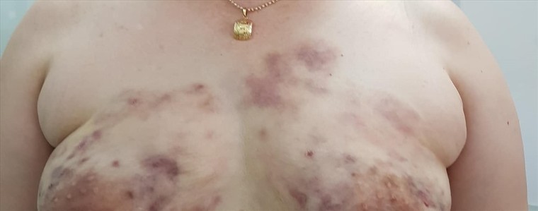 Hoại tử mũi, nát ngực vì làm đẹp đón Tết ảnh 3