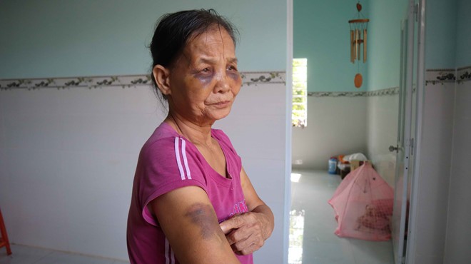 Vụ con dâu đánh mẹ chồng bầm tím mắt: Xin lỗi mẹ chồng tại công an xã ảnh 1