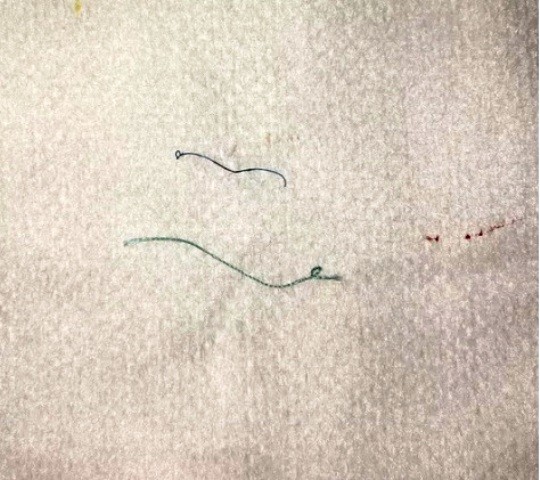 2 lần nhấn mí làm đẹp, cô gái trẻ hoảng sợ vì loét giác mạc, mắt mờ dần ảnh 1