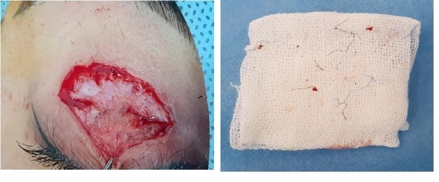 2 lần nhấn mí làm đẹp, cô gái trẻ hoảng sợ vì loét giác mạc, mắt mờ dần ảnh 2