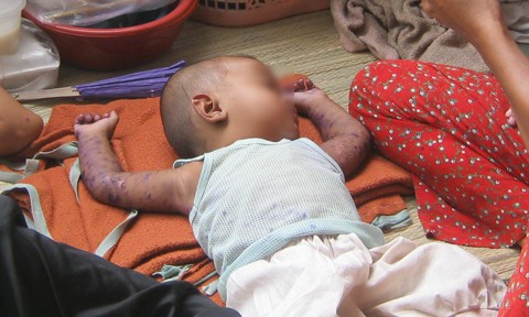 Chuyên gia chỉ cách nhận diện bệnh tay chân miệng ở trẻ em qua các giai đoạn ảnh 1