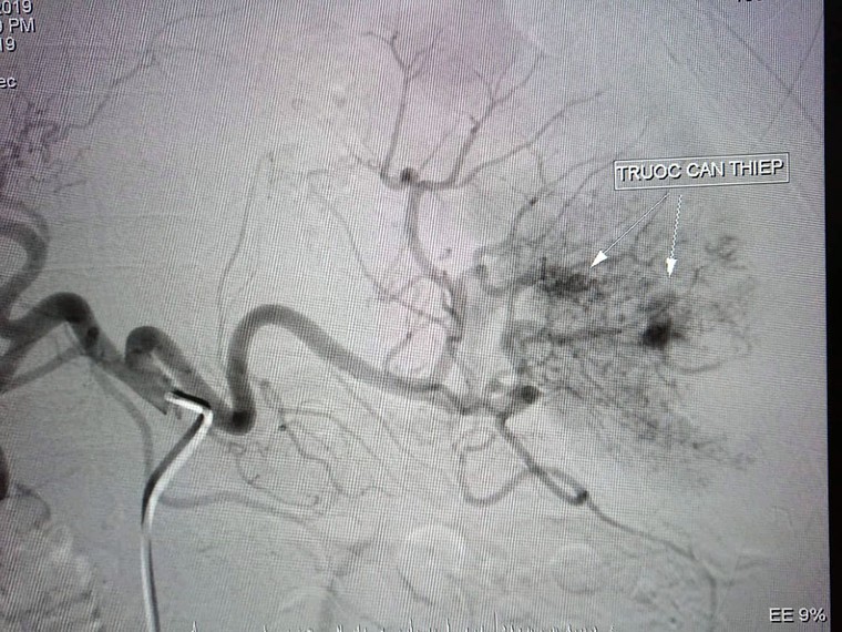 Người phụ nữ ở Cần Thơ tiểu ra máu 6 tháng liền do nguyên nhân hiếm gặp ảnh 1