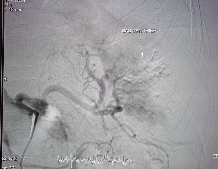 Người phụ nữ ở Cần Thơ tiểu ra máu 6 tháng liền do nguyên nhân hiếm gặp ảnh 2