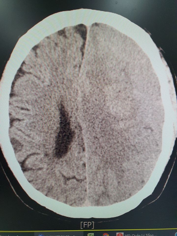 Cụ ông hôn mê vì uống An cung ngưu hoàng hoàn ngừa tai biến ảnh 1