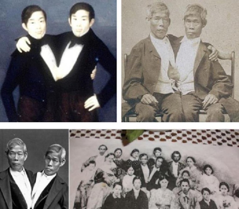 Kỳ lạ những cặp song sinh dính liền sống rất lâu dù không mổ tách ảnh 1