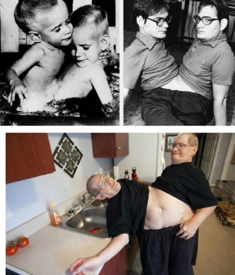 Kỳ lạ những cặp song sinh dính liền sống rất lâu dù không mổ tách ảnh 2