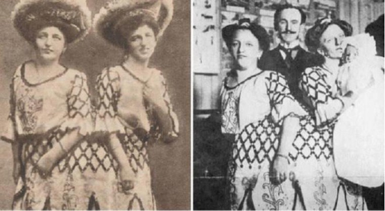 Kỳ lạ những cặp song sinh dính liền sống rất lâu dù không mổ tách ảnh 3