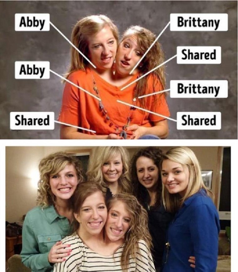 Kỳ lạ những cặp song sinh dính liền sống rất lâu dù không mổ tách ảnh 5