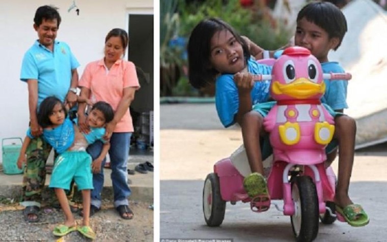 Kỳ lạ những cặp song sinh dính liền sống rất lâu dù không mổ tách ảnh 6