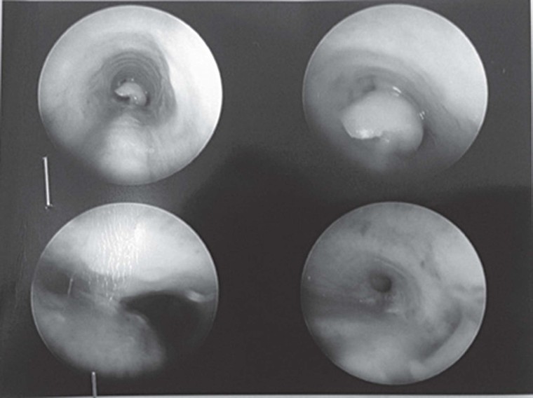 Dị vật đường thở với trẻ: Mối lo lớn từ những… vật nhỏ ảnh 1