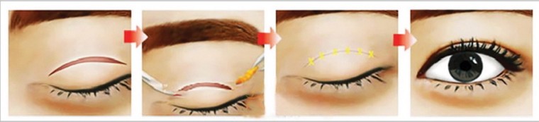 Phẫu thuật làm đẹp cho mắt - Hệ lụy khôn lường ảnh 1