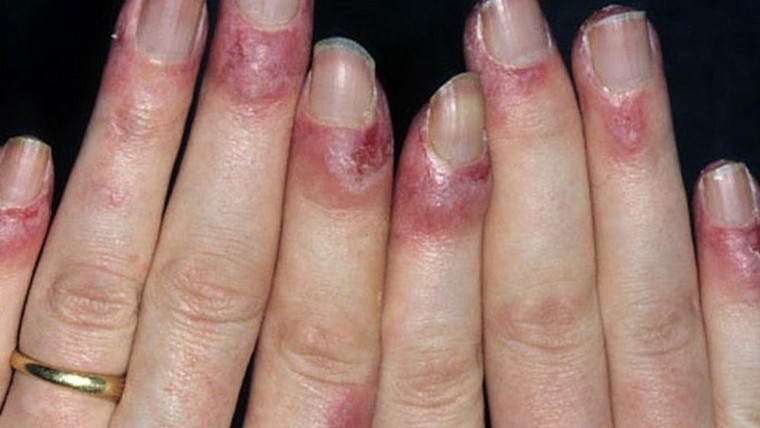 Cần làm gì để phòng ngừa tổn thương cơ thể do nhiệt độ thấp ảnh 1