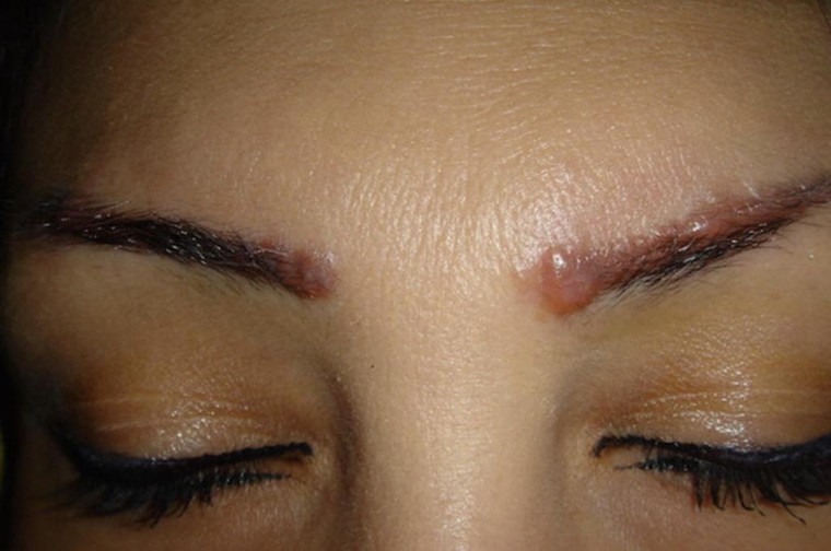 Nhiều rủi ro tiềm ẩn khi phun xăm thẩm mỹ tại nhà ảnh 1