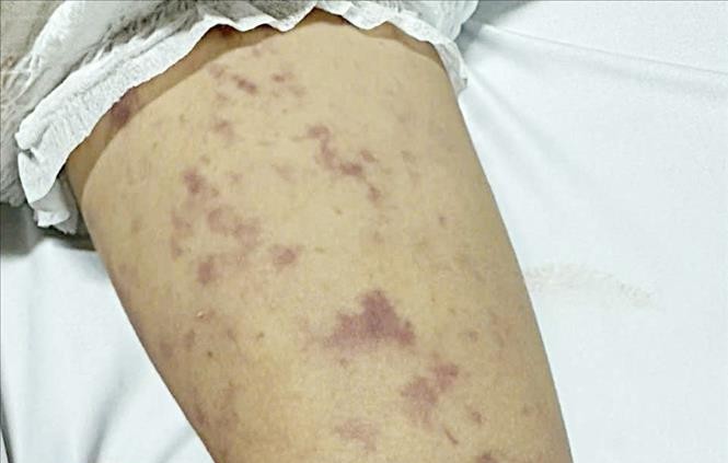 Đắk Lắk: Phát hiện 2 trường hợp mắc viêm não mô cầu, triển khai gấp công tác truy vết ảnh 1