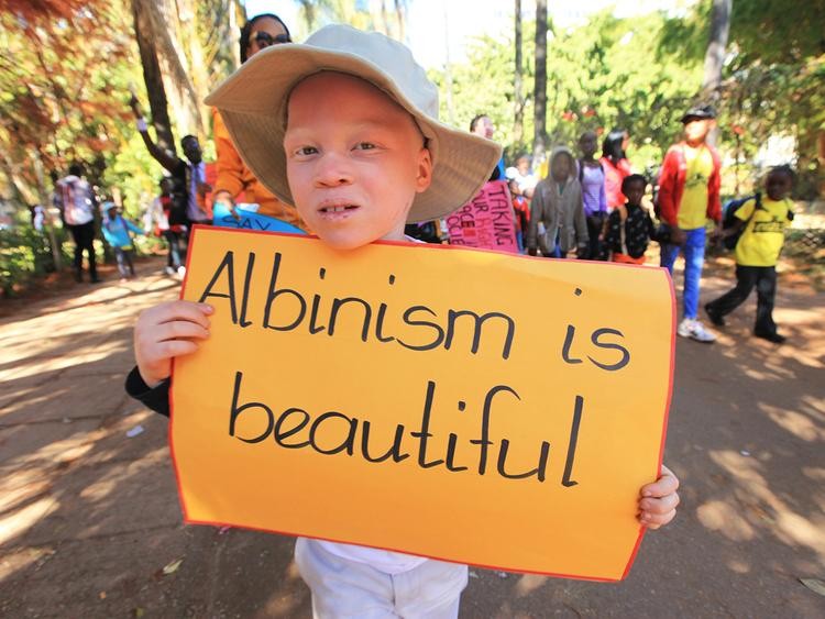 LHQ lên án bạo lực và phân biệt đối xử nhân Ngày Nhận thức về bệnh Bạch tạng Thế giới 13/6 ảnh 3