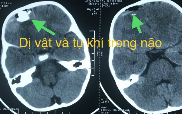 Nghịch súng bắn chim, bé trai 33 tháng tuổi bị đạn bi bắn xuyên sọ não ảnh 1