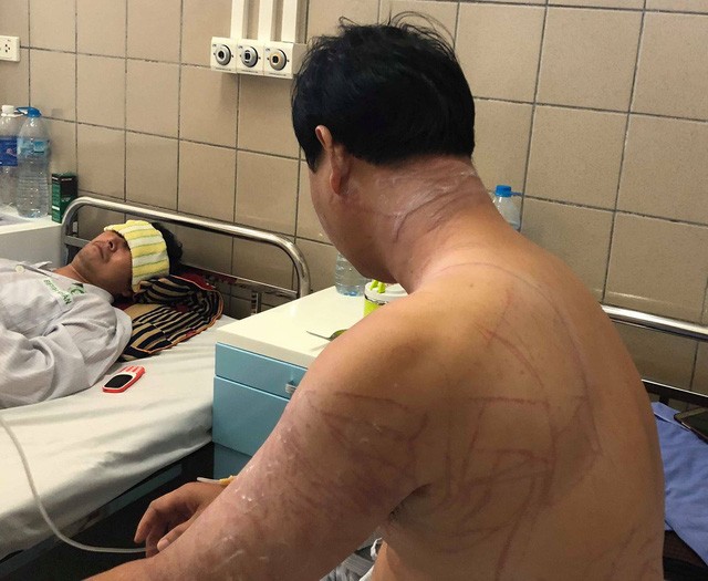 Người đàn ông bị chằng chịt vết thương do sứa khổng lồ đốt khi tắm biển ảnh 1