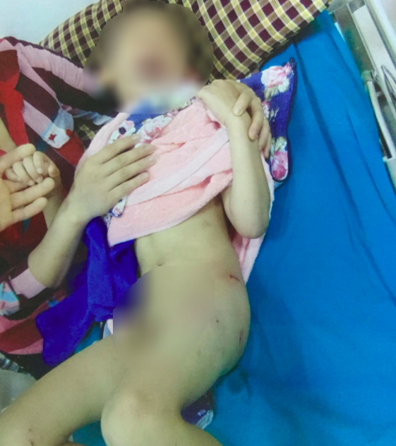 Bé trai 6 tuổi bị chó hàng xóm cắn nát mông, đùi khi chơi ở trong sân ảnh 1