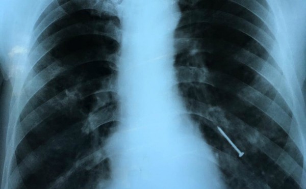 Hy hữu: Cây đinh gỉ sét 'chui' vào phổi người đàn ông suốt 4 tháng ảnh 1