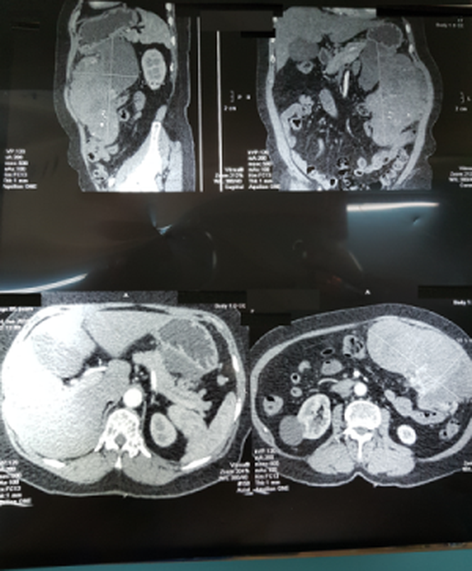 Bác sỹ toát mồ hôi cứu người phụ nữ suýt chết vì khối u khủng ảnh 1
