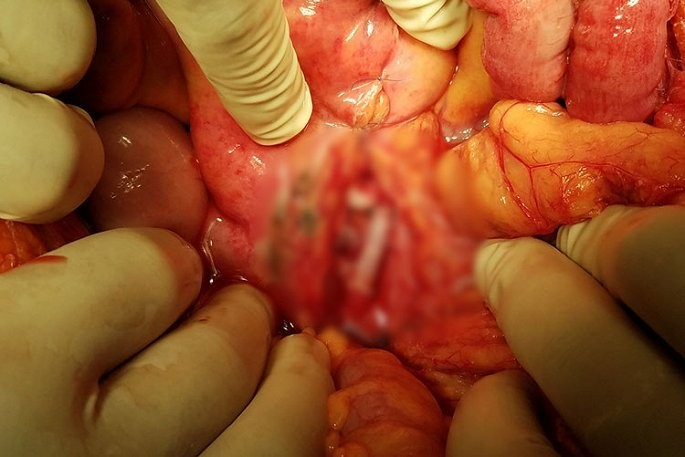 Cứu thành công nam thanh niên dập vỡ nhiều cơ quan nội tạng vì bị đá rơi trúng ảnh 1