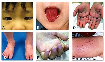 Kịp thời cứu chữa bé trai 3 tháng tuổi mắc bệnh Kawasaki hiếm gặp ảnh 1