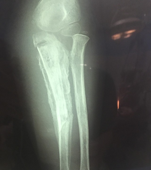 Cháu bé 5 tuổi bị hoại tử xương do đắp lá cây chữa gãy tay ảnh 1