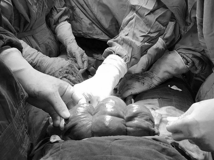 Giữ lại tử cung cho sản phụ băng huyết sau sinh bằng mũi khâu đặc biệt ảnh 1