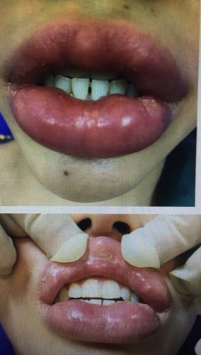 Kinh hoàng làm đẹp bằng filler ảnh 1