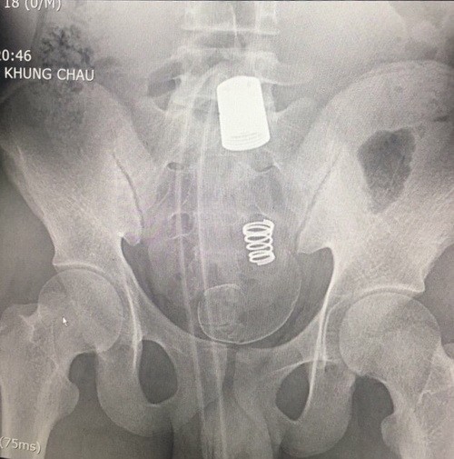 Rửa vệ sinh, nam thanh niên bị đầu vòi xịt bồn cầu chui tọt vào ổ bụng ảnh 1