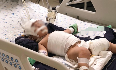 Bị ấm nước sôi ập thẳng vào người, bé gái bị bỏng thương tâm ảnh 1