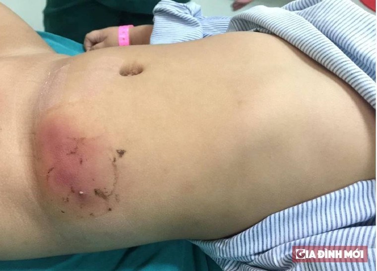 Mẹ tự ý dán cao chữa mụn khiến con phải nhập viện cấp cứu ảnh 1