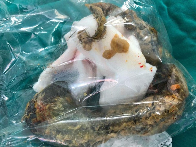 Bé gái 6 tuổi bị búi tóc khổng lồ chặn ngang đường ruột ảnh 1